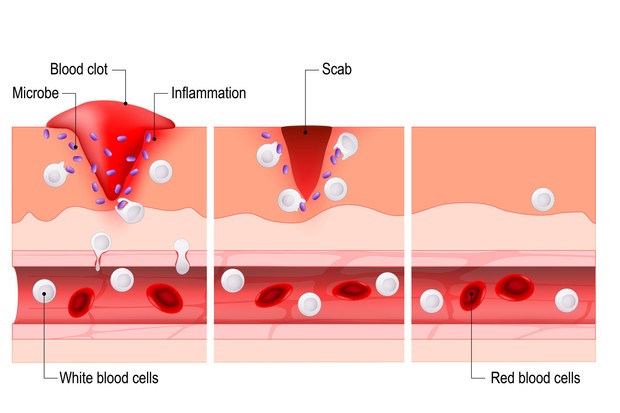 processus de cicatrisation des plaies.  Hémostase, Inflammatoire, Proliférative, Maturation et remodelage.  Lésion et inflammation des tissus.  Système immunitaire.  diagramme vectoriel à usage médical, éducatif et scientifique.